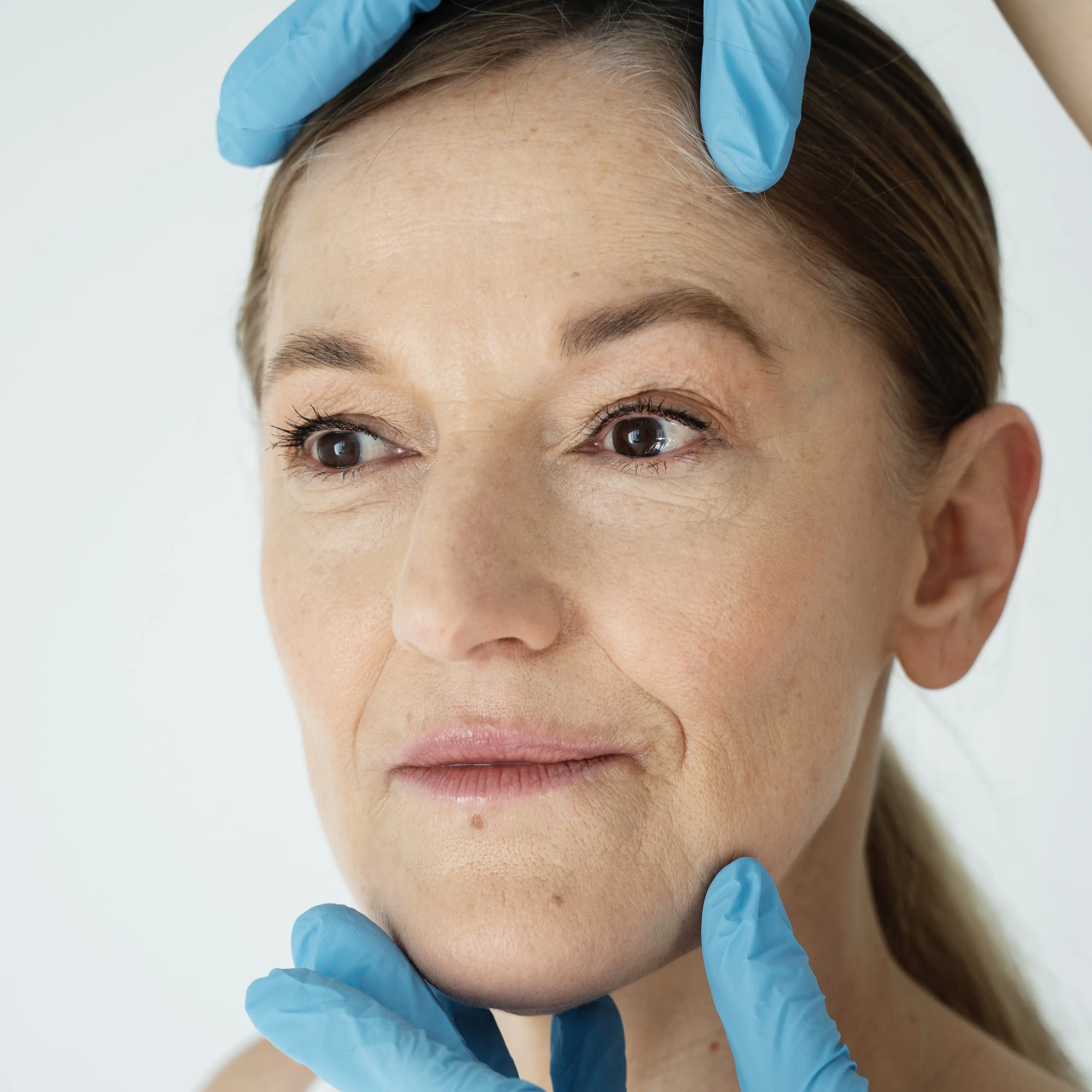 microneedling essence orion