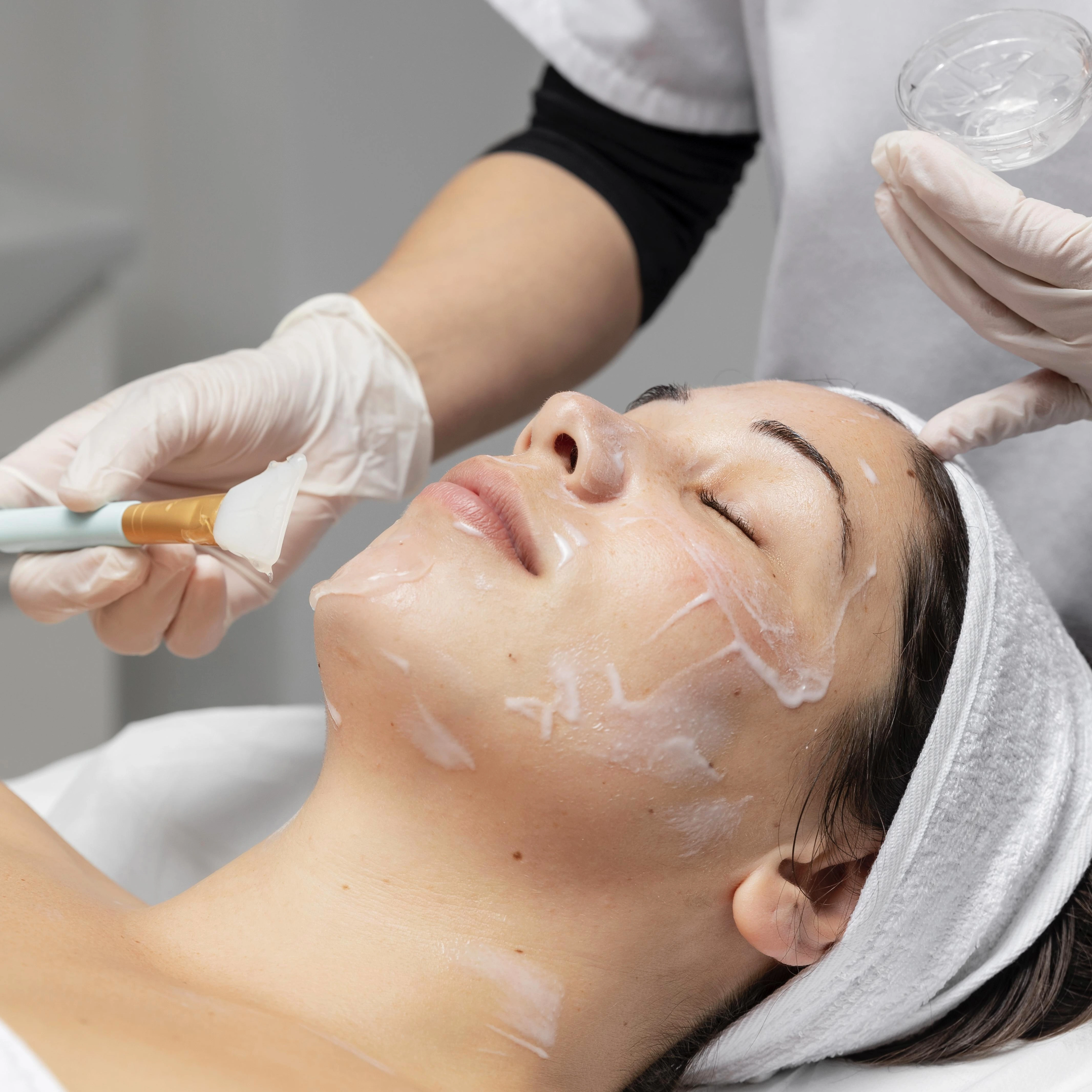 Peeling Facial (4 sesiones)